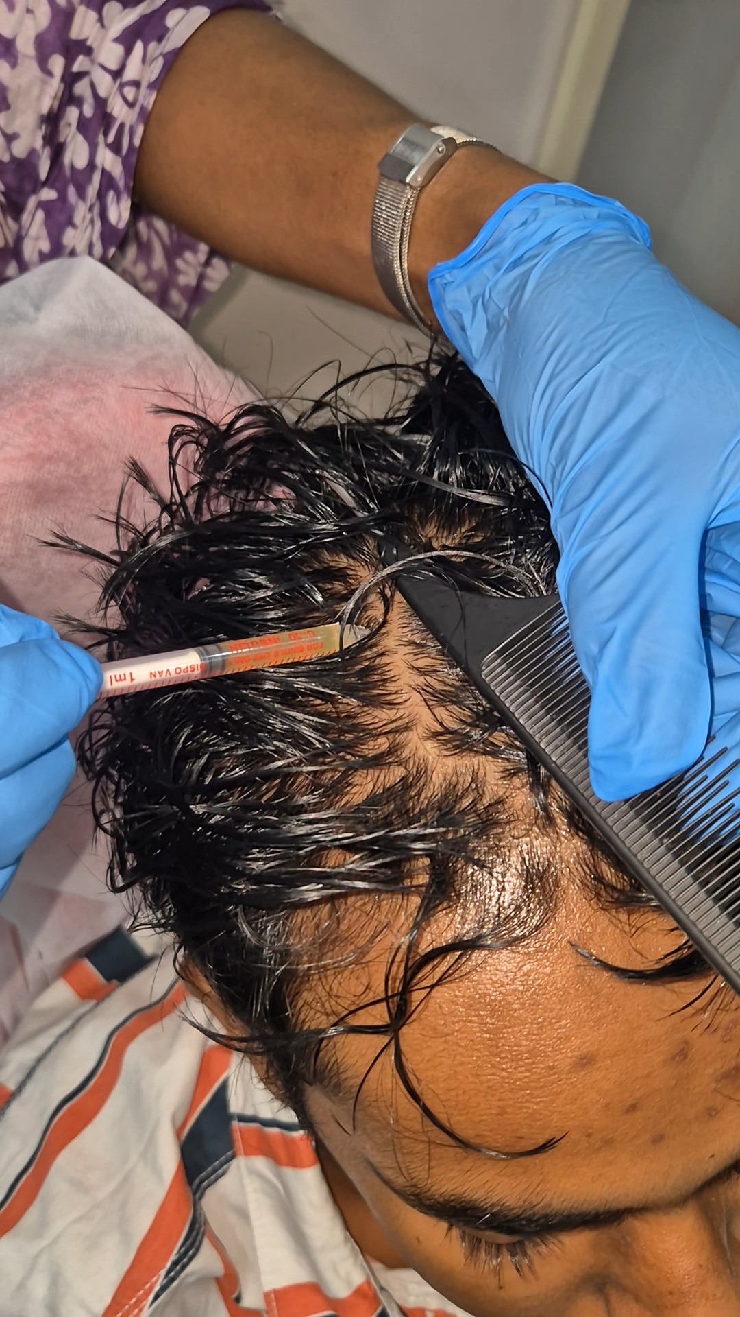 GFC/PRP for Scalp Story